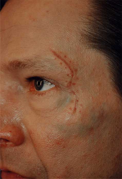 is a one of the stages of the healing of a wound on actor chris cooper ...
